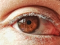retinopatia diabetica