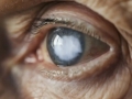 glaucoma