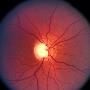 Glaucoma