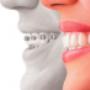 Invisalign