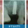 Impianto Dentale4
