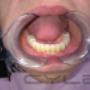 Caricato da visitatore il 26/04/2016 - Protesi fissa in ceramica costruita sugli impianti mostrati nelle precedente immagine.