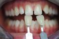 faccette dentali customizzate