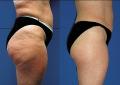 Trattamenti Dimagranti Corpo