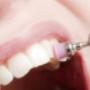 Otturazioni Dentistiche - Studio Dentistico De Medicis