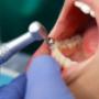 Sbiancamento Dentale - Studio Dentistico De Medicis
