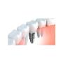 Impianti Dentali