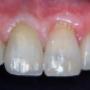 Corona zirconio-ceramica 11