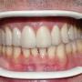 Corone zirconio-ceramica 12-11-21-22