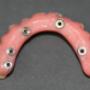 Protesi Overdenture su impianti
