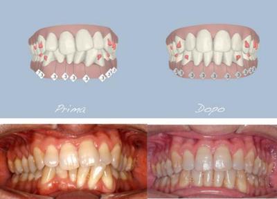 invisalign