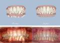 La tecnica "Invisalign®"