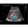 Eco Color Doppler