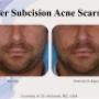 Acne pre e post