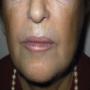 Filler codice a barre dopo