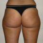 Liposuzione coullotte de cheval prima