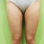 Liposuzione gambe dopo