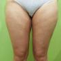 Liposuzione gambe prima