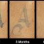 Rimozione tatuaggio